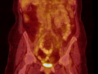 PET-CT scans taken of a patient after treatment